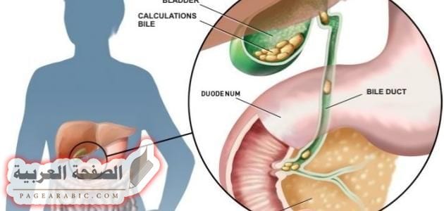 طريقة علاج آلام المرارة